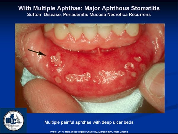 diagnosed with Stomatitis.