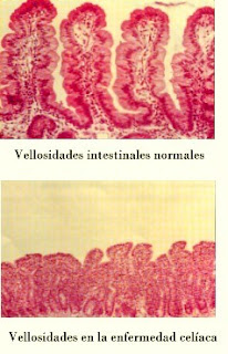 Vellosidad del intestino normal y con celiaquia