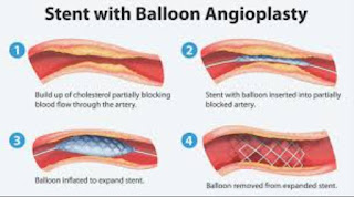 Balon Angioplasti - Balon Angioplasti Adalah - Proses Angioplasti - Resiko Penggunaan Balon Angioplasti I www.ProfesionalMassage.com