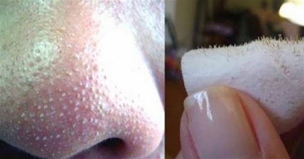 remove-blackheads.jpg