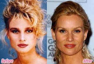 Female Celebrities pictures before and after plastic surgery