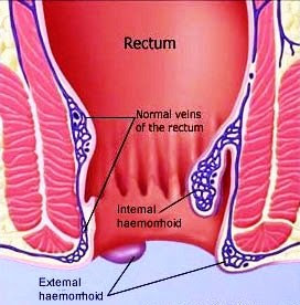 What Are Haemorrhoids