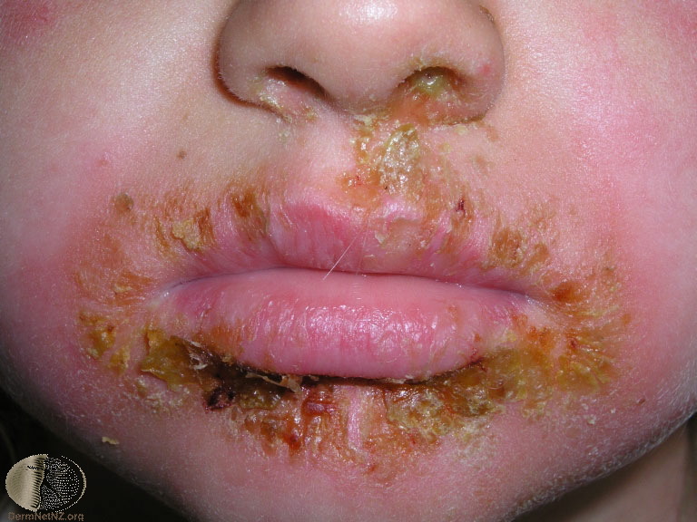 history  impetigo