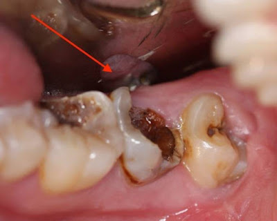Điều trị răng sâu bị nhức bằng cách nào?