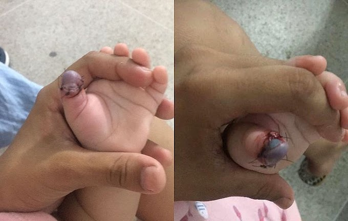 Dedo de bebê inchado e com odor forte após suposta negligência no HGE de Alagoas