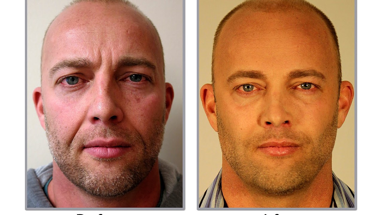 Cleft Lift Surgery