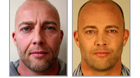Cleft Lift Surgery
