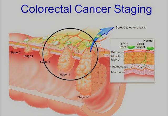 Colon And Rectal Cancer Types Of Blood Transfusion