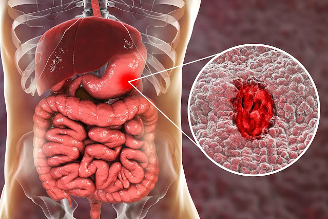 WHAT IS STOMACH ULCER?REASONS,CAUSES,TREATMENT