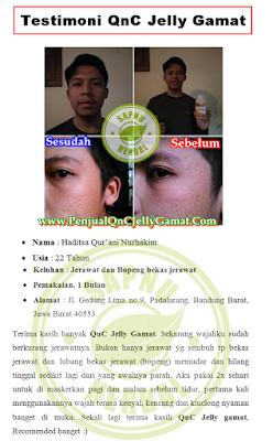 Cara Mengobati Lentigo Secara Alami, Obat lentigo Herbal QnC Jelly Gamat Di Apotik 100% Paling Ampuh