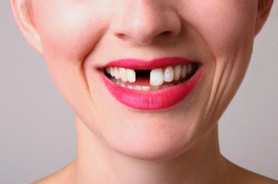 Hậu quả khôn lường khi mất răng