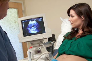 cara cepat hamil setelah operasi kista