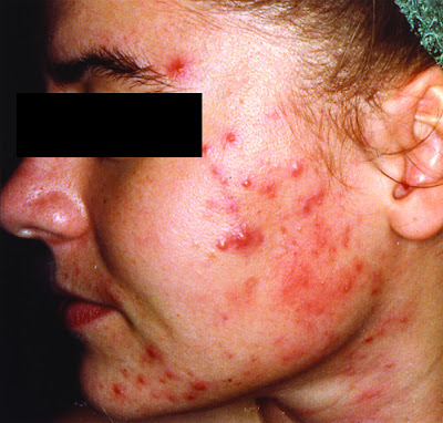 Treatment of Acne