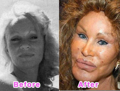 Celebrity Plastic Surgery Disasters