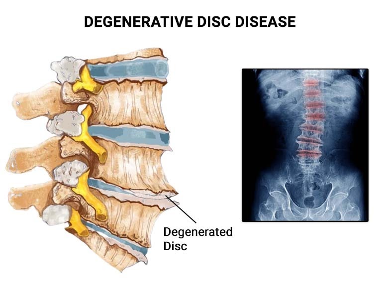 Say Goodbye to Back Pain: Discover Easy and Effective Treatments for Degenerative Disc Disease in India!