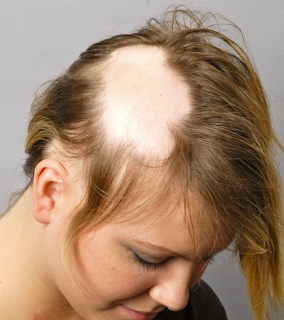 Hair Loss In Women 