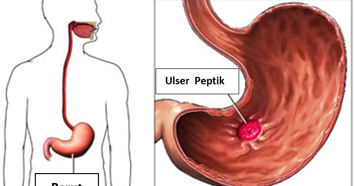 Ubat Gastrik Terbaik