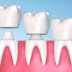 Răng bị hô có nên bọc sứ không?