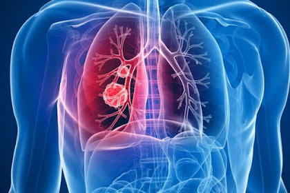 End stage of mesothelioma symptoms you must know