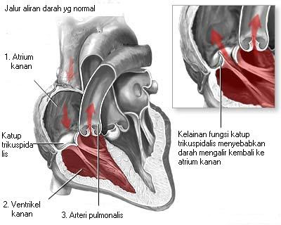 Regurgitasi katup trikuspidalis