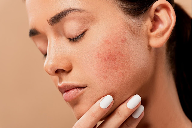 5 Acne Treatment Tips You Can Use Today