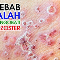 cara mengobati cacar herpes