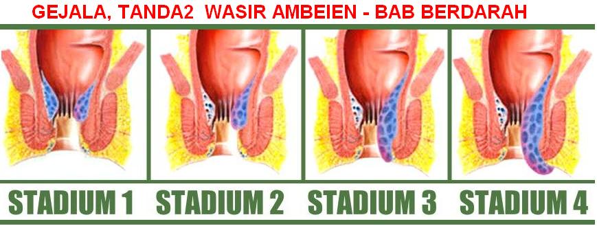 obat wasir ampuh di apotik