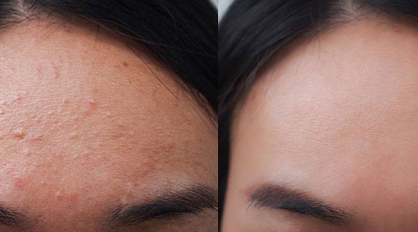 Tips To Get Rid Of Pimples On The Forehead