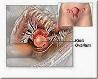 http://sehatmasakini.blogspot.com/2014/09/solusi-untuk-mencegah-penyakit-kista.html