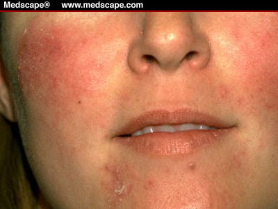  a common skin condition that causes redness and small bumps on the face.