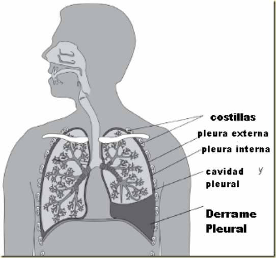 Pleuraleffusion