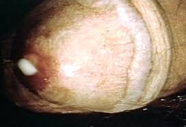 Sipilis