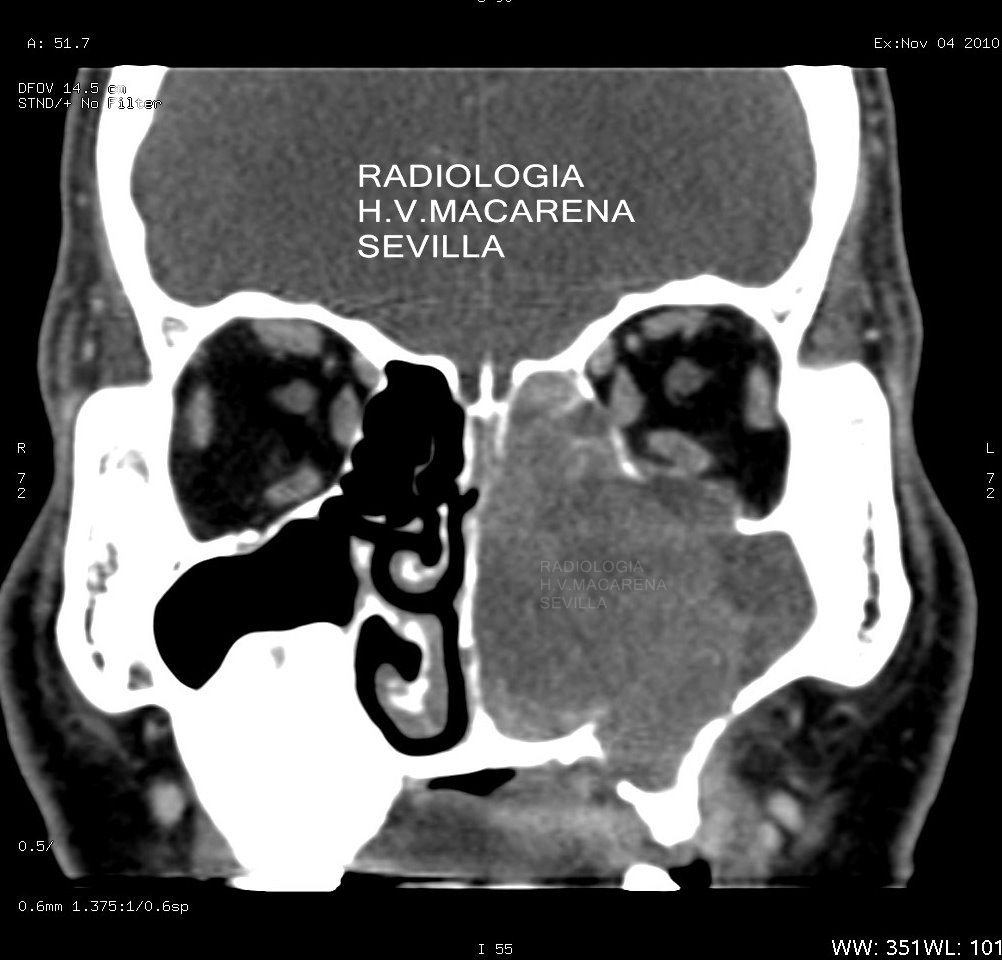 Neoplasia del seno maxilar