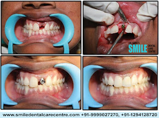 Painless Root Canal Treatment