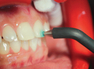 electrode placed on incisal third, electric pulp test, vitality test