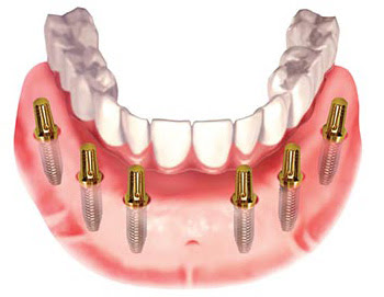 Quy trình làm răng Implant đạt chuẩn quốc tế  với công nghệ mới