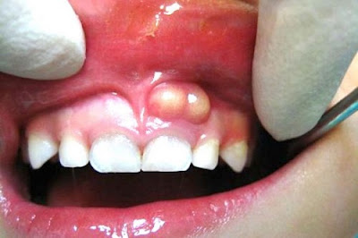 Cảnh báo tình trạng viêm chân răng có mủ gây nhiều nguy hại 1