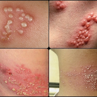 Solusi Terbaik Menghilangkan Berbagai Jenis Penyakit Herpes