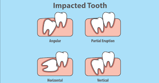 All you need to know about impacted wisdom molars extractions