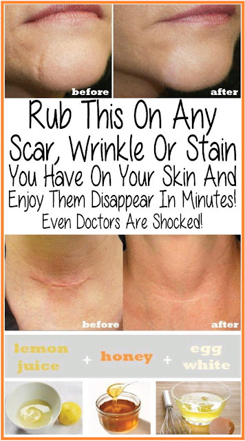 Rub This On Any Scar,Wrinkle Or Stain You Have On Your Skin And Enjoy Them Disappear In Minutes! Even Doctors Are SHOCKED!