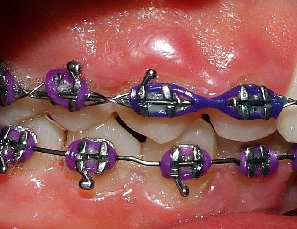 Orthodontic Periodontic