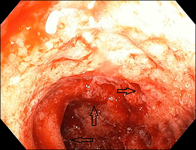 Segmental Colitis Associated with Diverticulosis