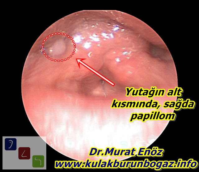 Pharyngeal Papilloma