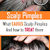 Scalp Pimples: What Causes them and how to Treat them