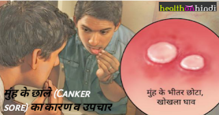 mouth ulcers,mouth ulcer home remedy,how to remove a mouth ulcer fastmuh se badbu ka ilaj,muh ki badbu kaise dur kare,muh se badbu aana