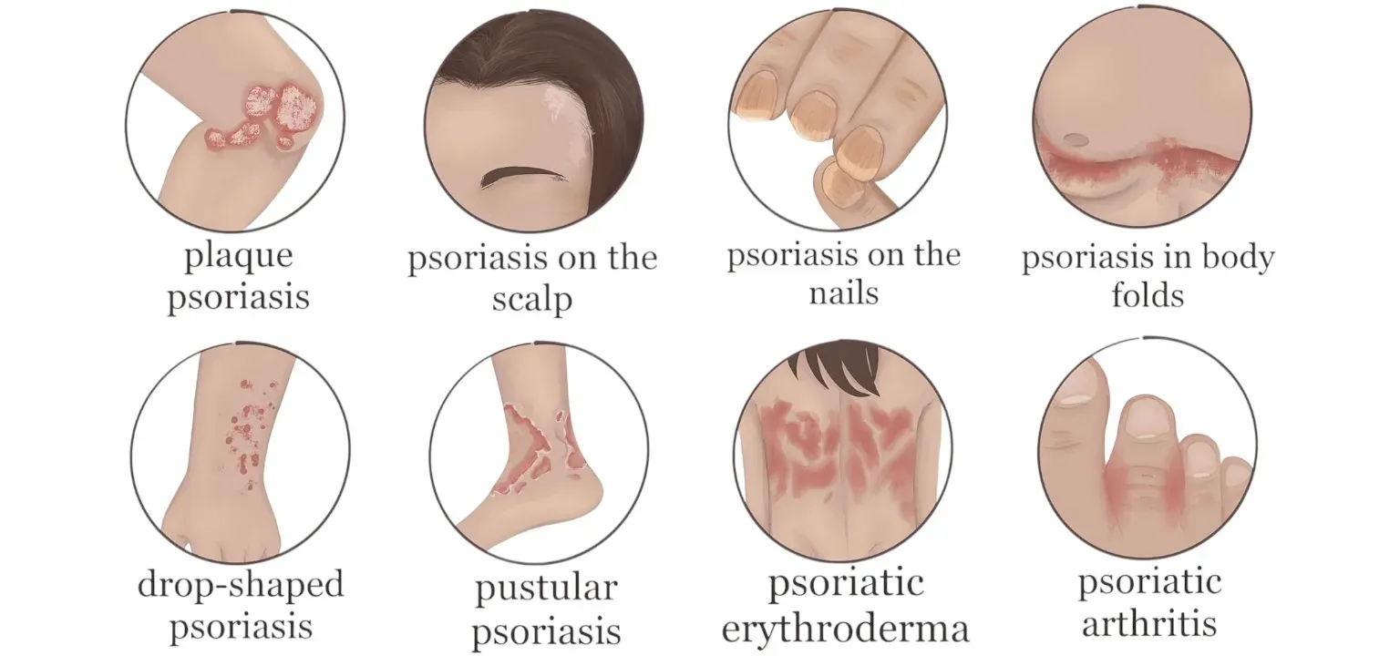 Psoriasis Symptoms and causes