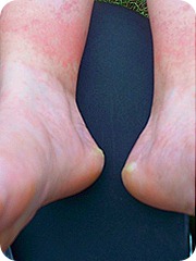 blisters me