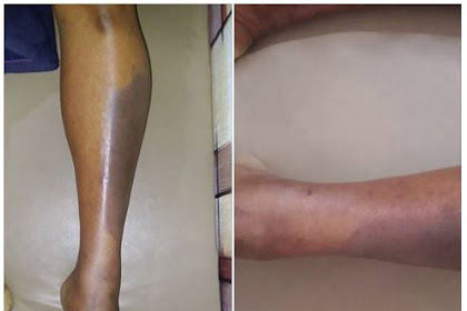 Tentang Acute Limb Ischemia (ALI)
