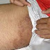 Obat Gatal Alami Untuk Infeksi Jamur Di Area Penis
