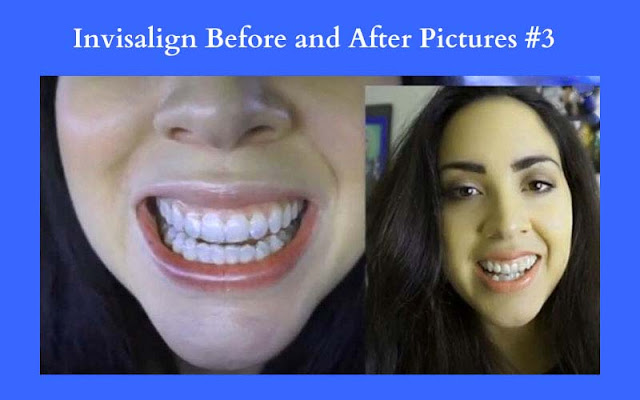 Invisalign Before and After 